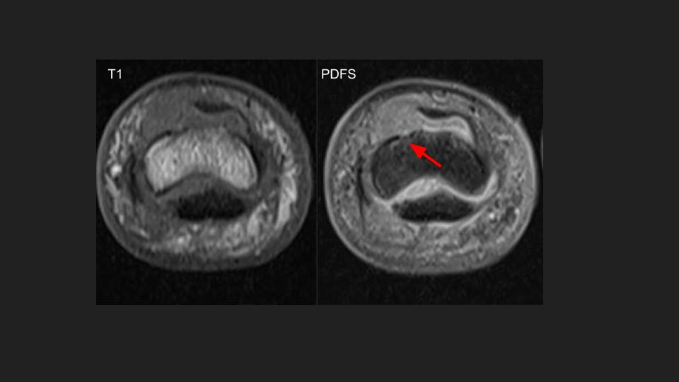 Figure 1 for case infectious or inflammatory disease ( RID3381 )